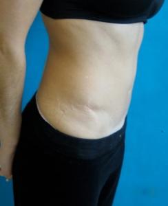 tummy_tuck_B_post_2